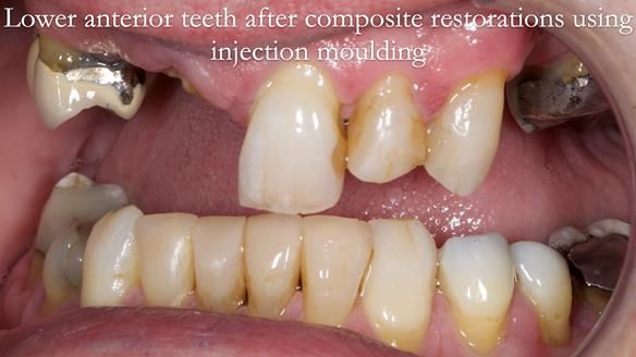 Read Newsletter 67 - Brian's COMBAT DENTURE Case Study