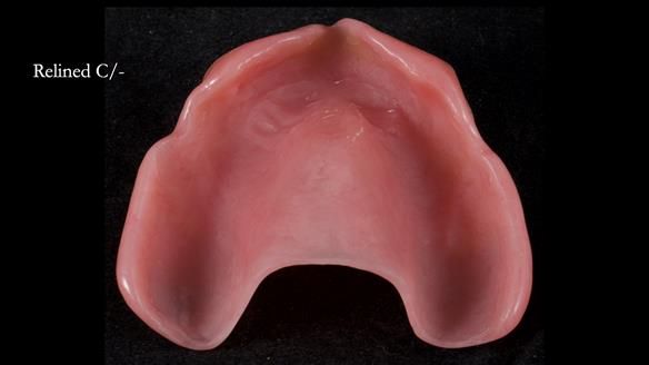 Newsletter 77: Jeremy’s case – immediate complete upper denture