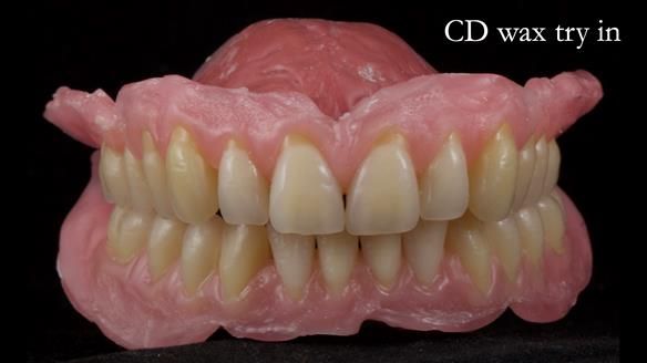 Finlay's Newsletter 62 provision of extractions and metal based complete dentures for Rafique