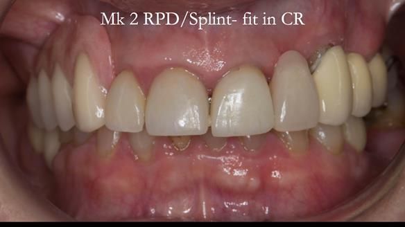 Newsletter 51 Managing Anne’s failing dentition with distal extension base RPD/Splint FULL PROTOCOL