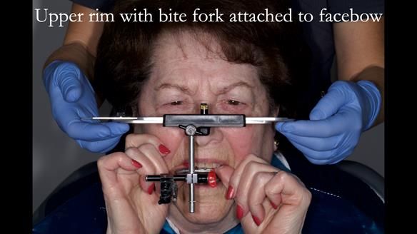 Finlay's Newsletter 60 Sylvia's upper Kennedy Class 2 Mod 1 metal based upper RPD