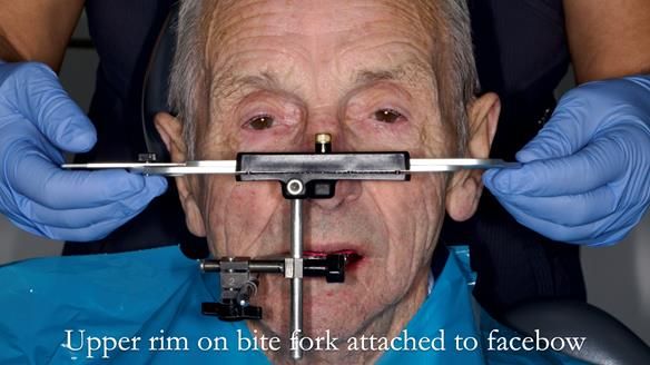 Newsletter 80 - Gordon’s dentures: the one case in 1,000 where my technique failed