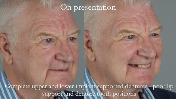 Newsletter 57 showcases the making and fitting process of implant-supported complete dentures for Alisdair