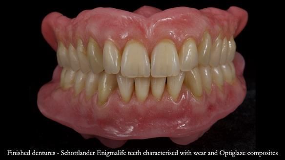 Newsletter 80 - Gordon’s dentures: the one case in 1,000 where my technique failed