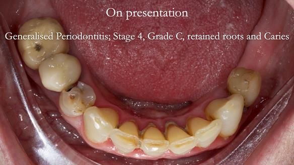 Newsletter 52 Managing Jo’s failing dentition with extractions and Mk 1/Mk 2 complete upper dentures and lower partial dentures FULL PROTOCOL