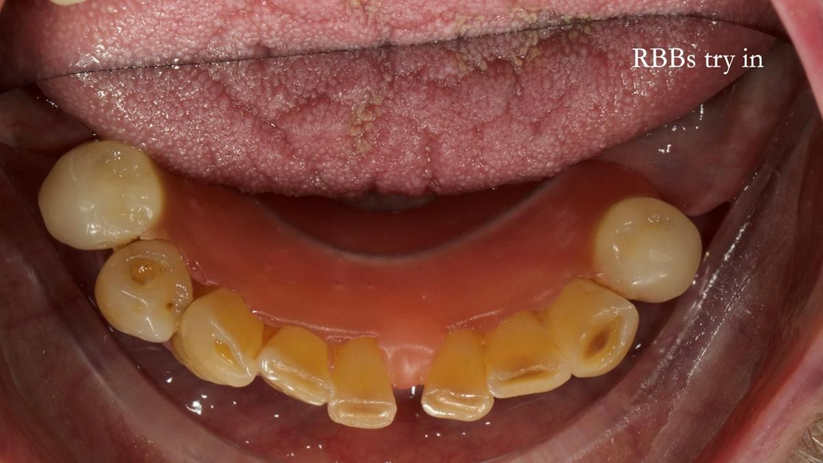 Newsletter 87 – Father Peter: A Partial Denture that needed Minor Miracle