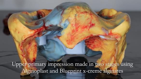 Finlay's Newsletter 62 provision of extractions and metal based complete dentures for Rafique