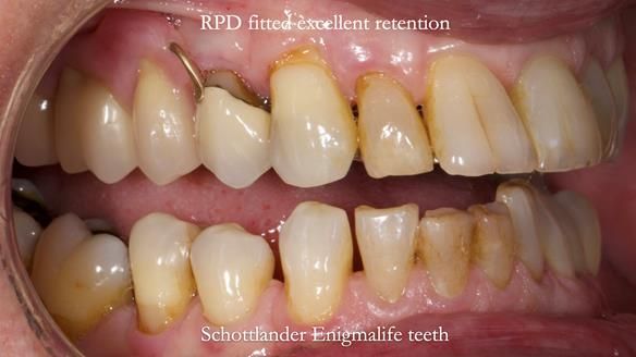 Finlay's Newsletter 64 case study - provision of a Kennedy class 2 metal based Scandinavian RPD for Ian