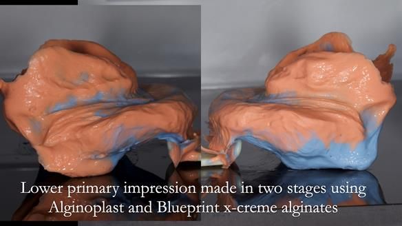 Newsletter 80 - Gordon’s dentures: the one case in 1,000 where my technique failed