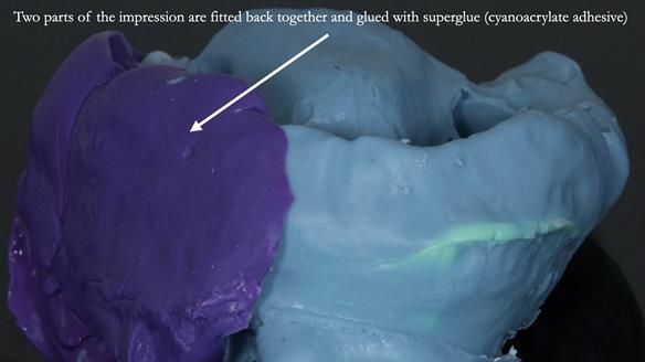 Newsletter 51 Managing Anne’s failing dentition with distal extension base RPD/Splint FULL PROTOCOL