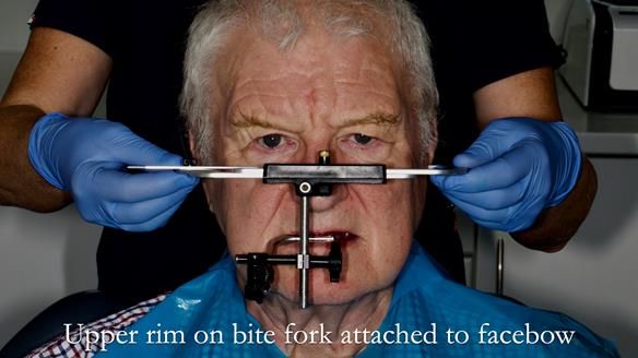 Newsletter 57 showcases the making and fitting process of implant-supported complete dentures for Alisdair