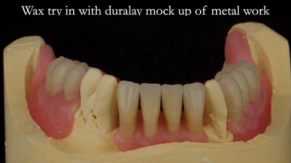 Finlay's Case Study Newsletter 40 - Immediate Mk 1 RPD to Definitive Mk 2 RPD - full protocol