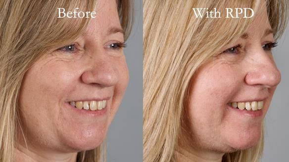 Solving Sue's failed implants with metal based RPD - full protocol Newsletter 43