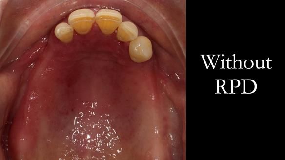 Finlay's Case Study Newsletter 40 - Immediate Mk 1 RPD to Definitive Mk 2 RPD - full protocol