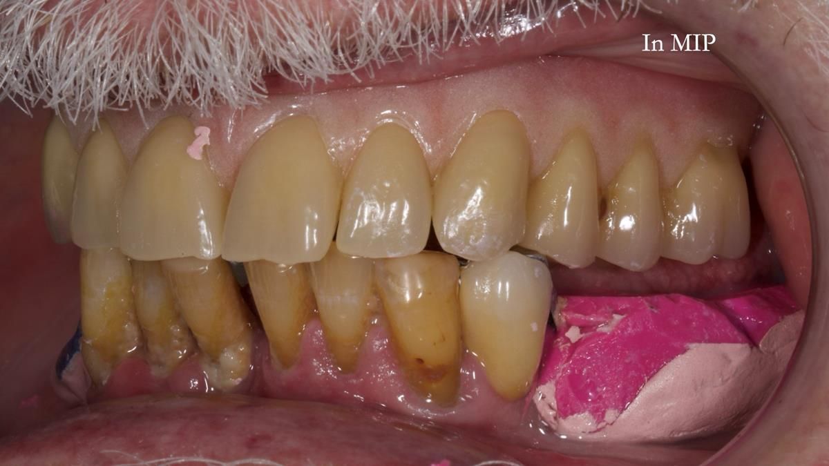 Newsletter 87 – Father Peter: A Partial Denture that needed Minor Miracle