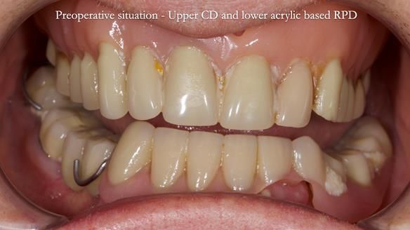 Newsletter 82 Mary - A complete upper and a one-tooth gasket denture