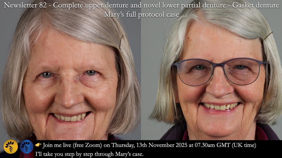Newsletter 82 Mary - A complete upper and a one-tooth gasket denture