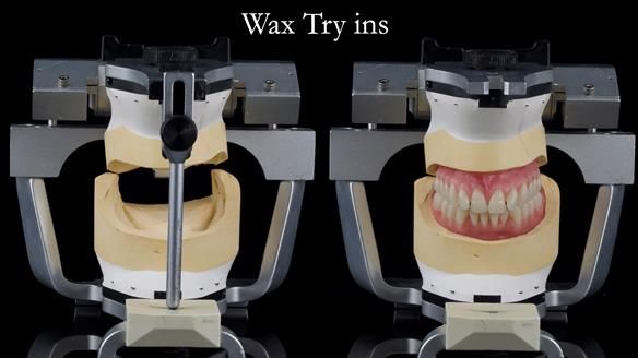 Replacing Madeline’s Complete denture FULL PROTOCOL