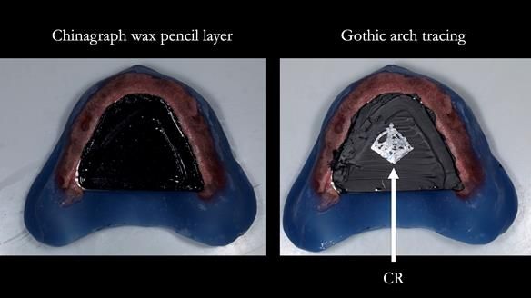Newsletter 78: What do Clark Gable and a Locator® overdenture have in common?