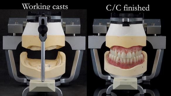 Managing poor implant positioning with complete dentures and Locator attachments - full protocol Newsletter 41