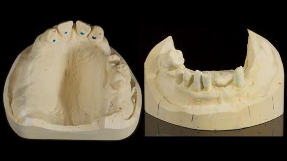 Newsletter 86 Peter the Architect — precision removable partial dentures case study