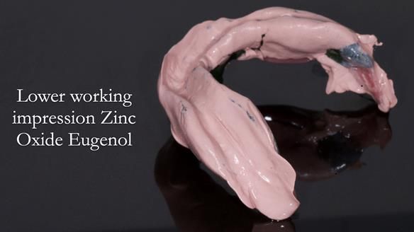 Finlay's Newsletter 62 provision of extractions and metal based complete dentures for Rafique