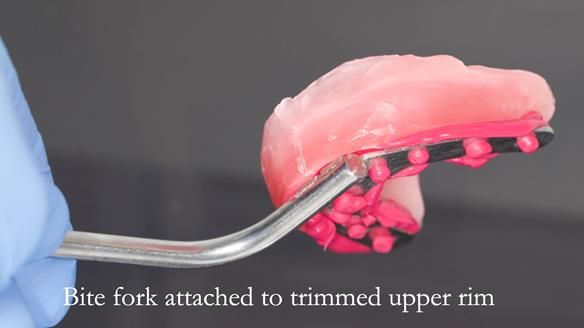 Newsletter 53 showing the making and fitting of ultra life-like dentures for Valena