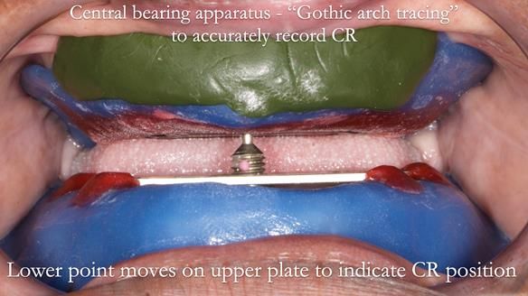 Newsletter 53 showing the making and fitting of ultra life-like dentures for Valena