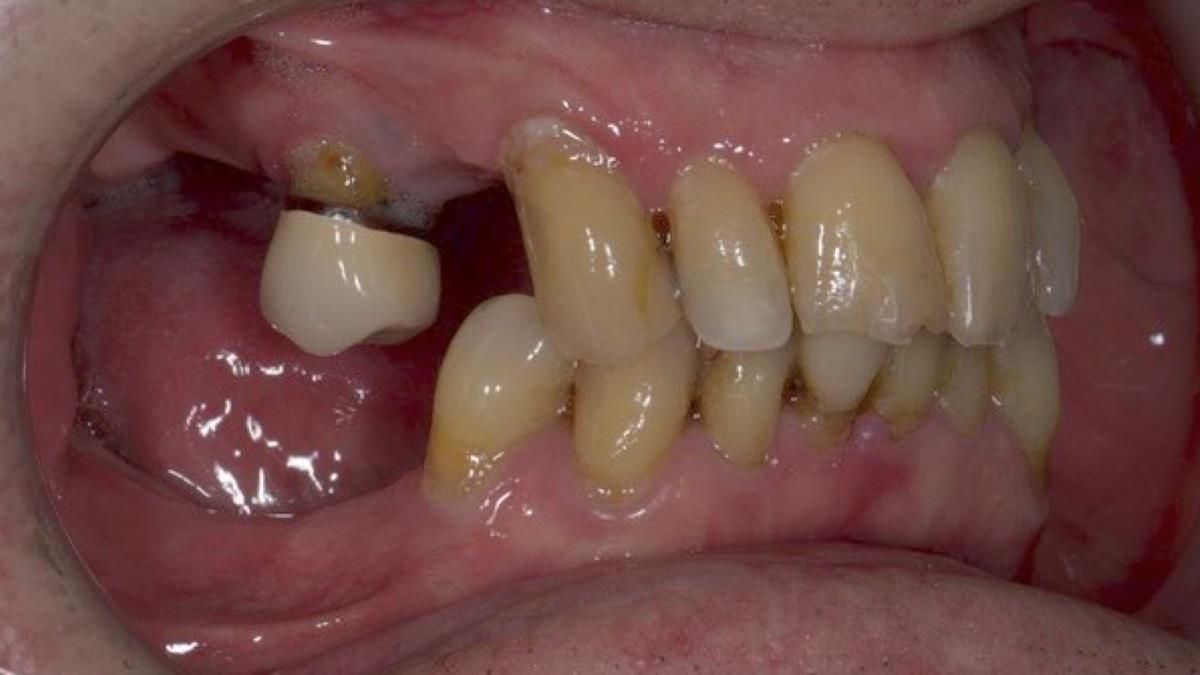 Newsletter 89 – Simon: A Challenging Kennedy Class II Division 1 Upper CoCr Partial Denture with a High Smile Line