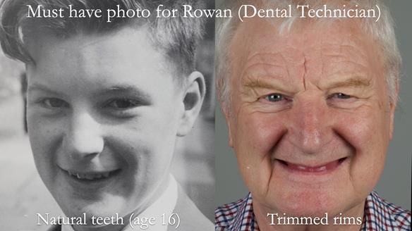 Newsletter 57 showcases the making and fitting process of implant-supported complete dentures for Alisdair