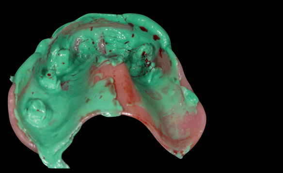 Figure 35 The light bodied silicone shows potential support problems where the acrylic pushes through