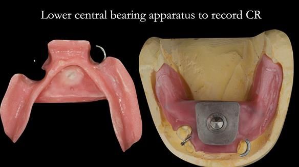 Finlay's Case Study Newsletter 40 - Immediate Mk 1 RPD to Definitive Mk 2 RPD - full protocol