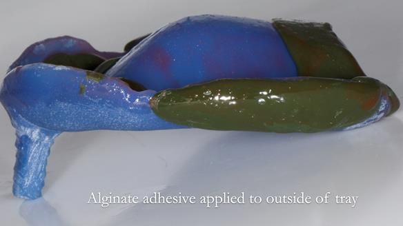 Newsletter 53 showing the making and fitting of ultra life-like dentures for Valena