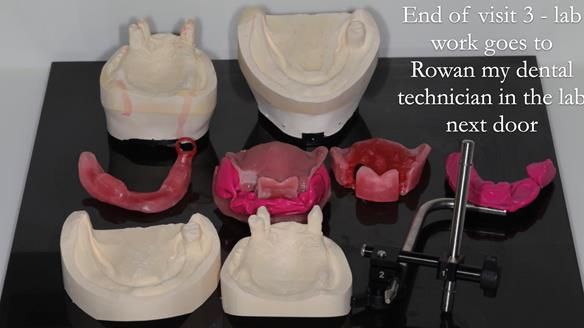 Finlay's Newsletter 59 Ultra hard partial dentures made for Gill