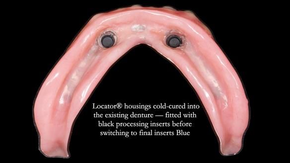 Newsletter 78: What do Clark Gable and a Locator® overdenture have in common?