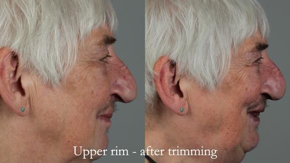 Newsletter 55 Provision of metal based partial dentures for Zephyrine with a repaired cleft lip and palate