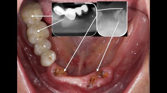 Newsletter 82 Mary - A complete upper and a one-tooth gasket denture