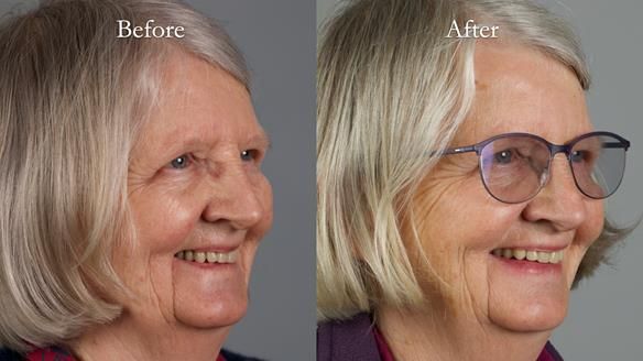 Newsletter 82 Mary - A complete upper and a one-tooth gasket denture