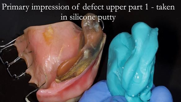 Upper metal base partial denture/occlusal stabilisation splint/obturator - full protocol