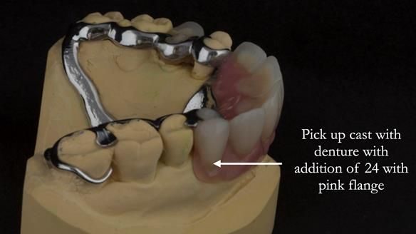 Finlay's Newsletter 63 Case study provision of metal based Scandinavian RPD - functional 10 years on