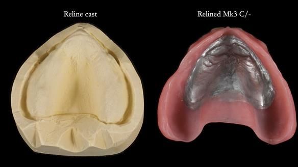 Newsletter 77: Jeremy’s case – immediate complete upper denture