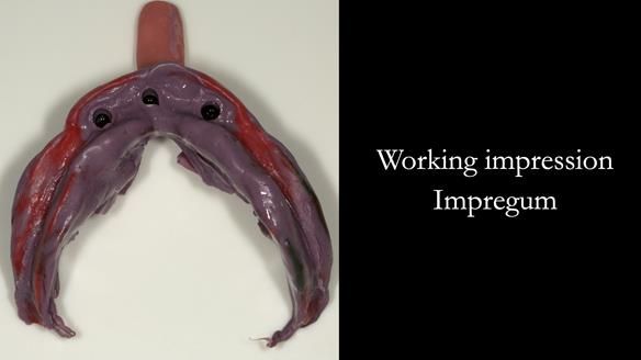 Close fitting tray - where the tray shows through the impression material is not a problem because the tray has been made to fit the accurate primary cast.