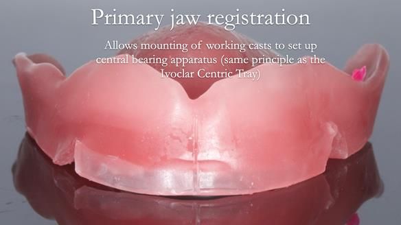 Newsletter 54 case presentation upper complete denture and lower Scandinavian designed hygienic partial denture for David