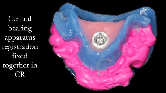 Finlay's Newsletter 58 Gasket upper partial denture for Zoe