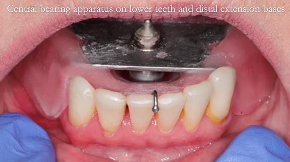 Newsletter 52 Managing Jo’s failing dentition with extractions and Mk 1/Mk 2 complete upper dentures and lower partial dentures FULL PROTOCOL