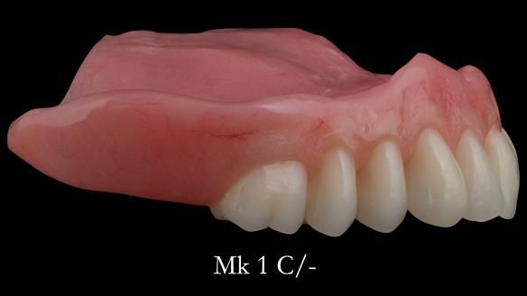 Newsletter 52 Managing Jo’s failing dentition with extractions and Mk 1/Mk 2 complete upper dentures and lower partial dentures FULL PROTOCOL