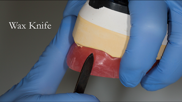 Figure 68 Lip support is prescribed by carving the rim with a wax knife