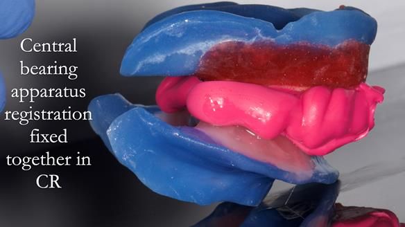 Newsletter 80 - Gordon’s dentures: the one case in 1,000 where my technique failed