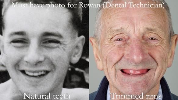 Newsletter 80 - Gordon’s dentures: the one case in 1,000 where my technique failed