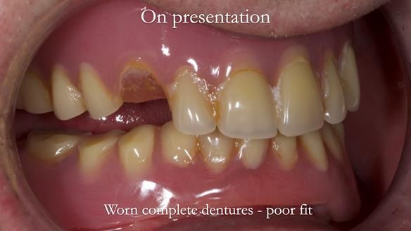 Newsletter 57 showcases the making and fitting process of implant-supported complete dentures for Alisdair